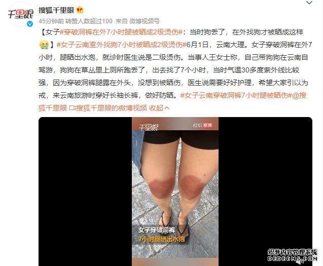 女子云南穿破洞裤7小时腿被晒伤 当时气温30多度紫外线比较强